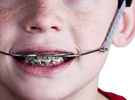 子供の矯正治療